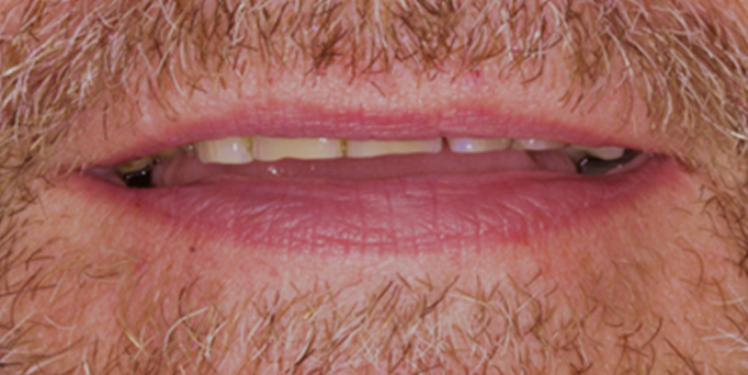 Before - Image - Serio Dental