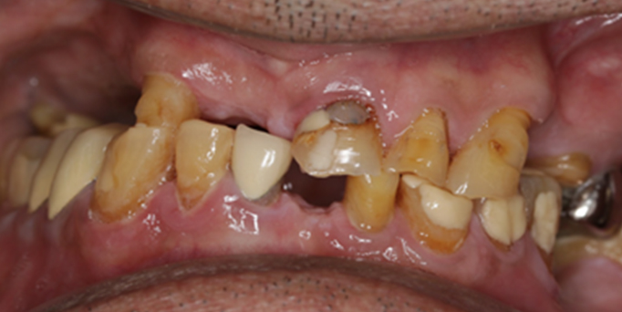 Before - Image - Serio Dental