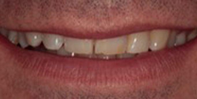 Before - Image - Serio Dental