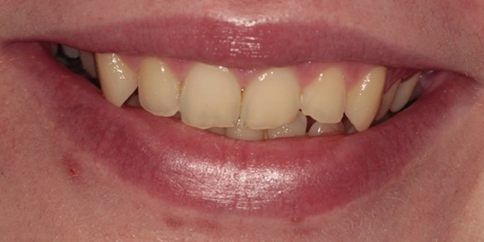 Before - Image - Serio Dental