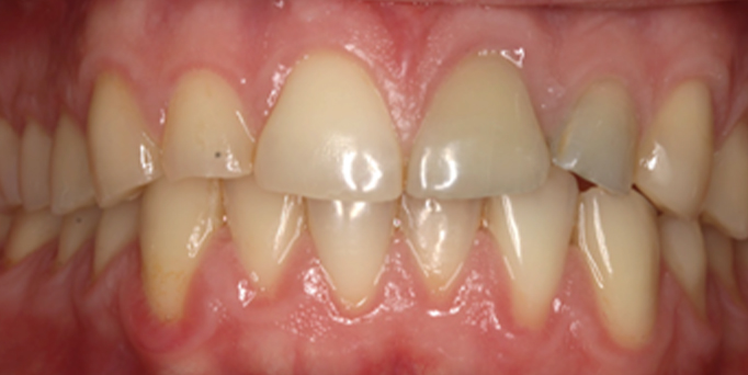 Before - Image - Serio Dental