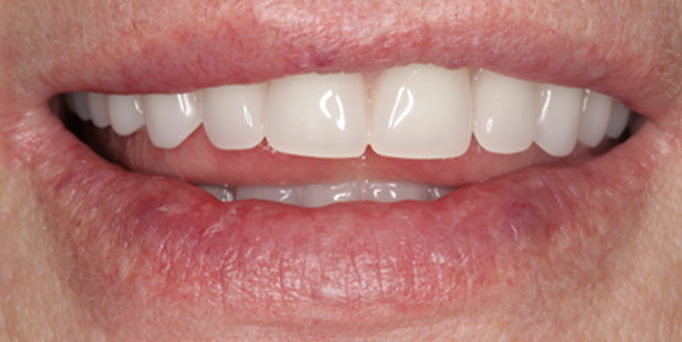 After- image - Serio Dental