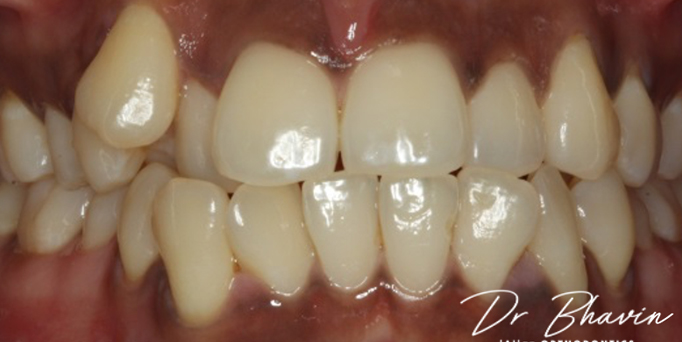 Before - Image - Serio Dental