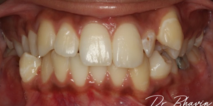 Before - Image - Serio Dental