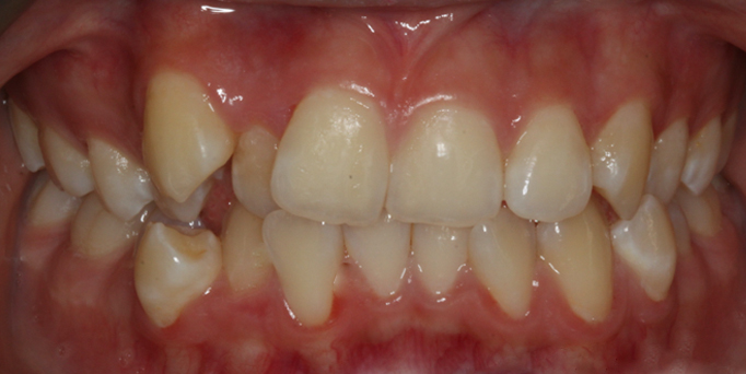 Before - Image - Serio Dental