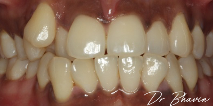 Before - Image - Serio Dental