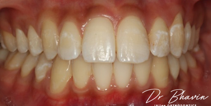 After- image - Serio Dental