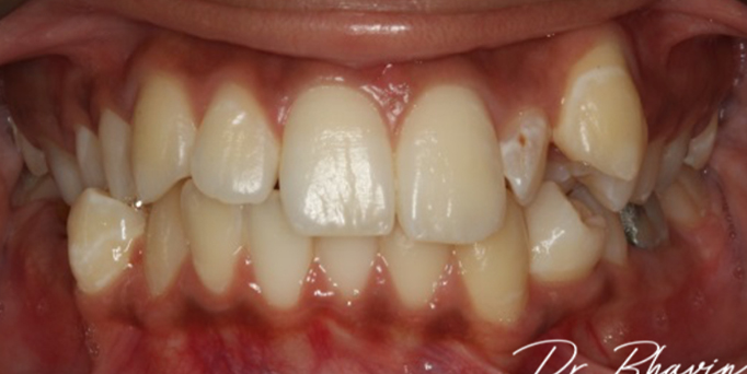 Before - Image - Serio Dental