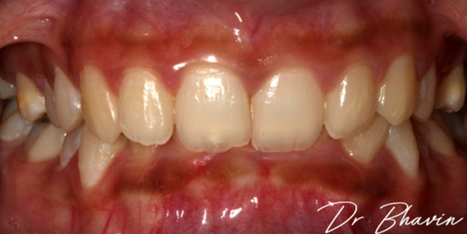 Before - Image - Serio Dental