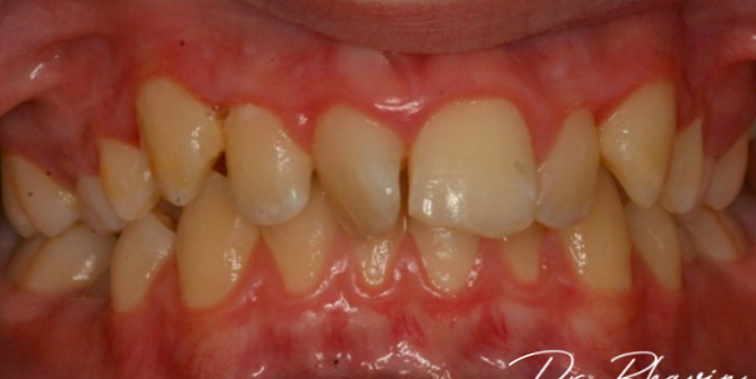 Before - Image - Serio Dental