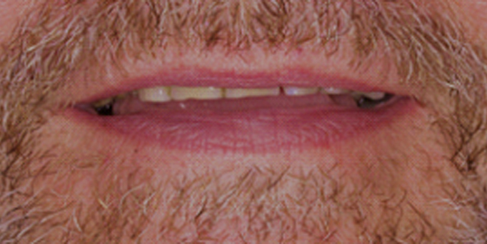 Before - Image - Serio Dental