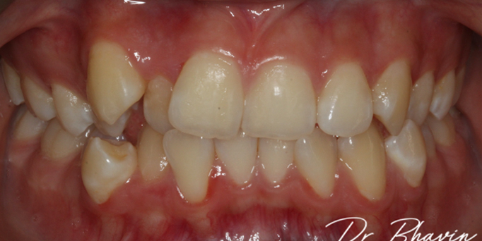 Before - Image - Serio Dental